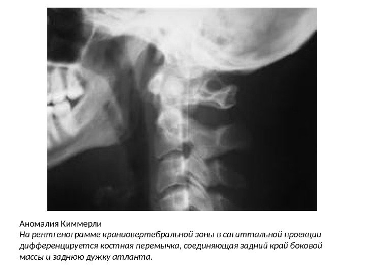 Аномалия Киммерли На рентгенограмме краниовертебральной зоны в сагиттальной проекции дифференцируется костная перемычка, соединяющая задний