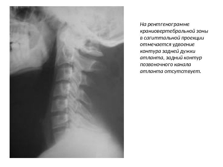 На рентгенограмме краниовертебральной зоны в сагиттальной проекции отмечается удвоение контура задней дужки атланта, задний
