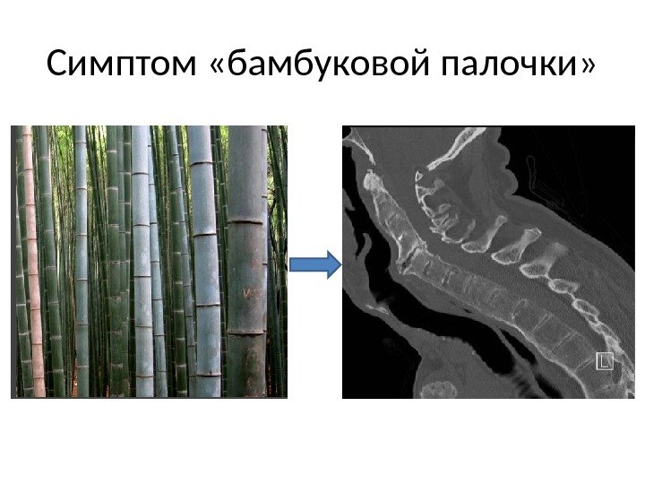 Симптом «бамбуковой палочки» 
