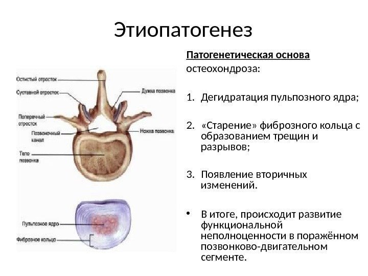 Этиопатогенез Патогенетическая основа остеохондроза: 1. Дегидратация пульпозного ядра; 2.  «Старение» фиброзного кольца с