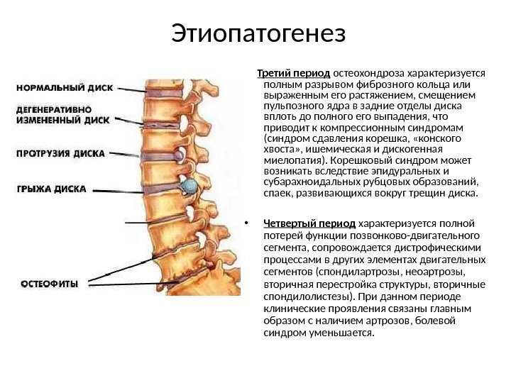  Третий период остеохондроза характеризуется полным разрывом фиброзного кольца или выраженным его растяжением, смещением