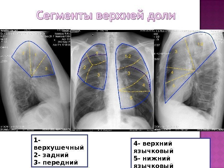 Сегменты легких на рентгене схема рентген