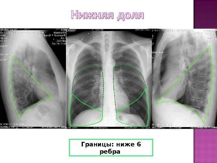 Изменения базальных отделов легких. Рентгеноанатомия грудной полости. Рентгеноанатомия грудной клетки. Заднебазальный сегмент легкого какие ребра.