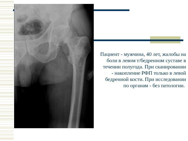 Пациент - мужчина, 40 лет, жалобы на боли в левом т/бедренном суставе в течении