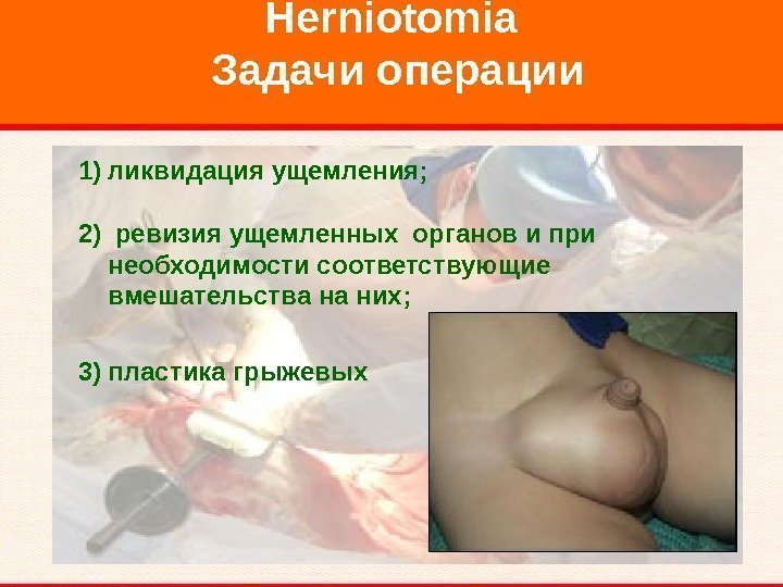   Herniotomia Задачи операции 1) ликвидация ущемления; 2)  ревизия ущемленных органов и