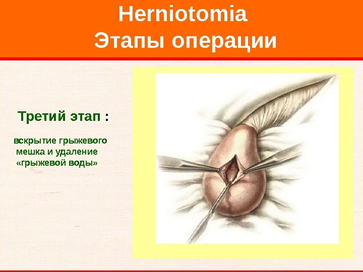   Herniotomia Этапы операции  Третий этап :  вскрытие грыжевого  мешка