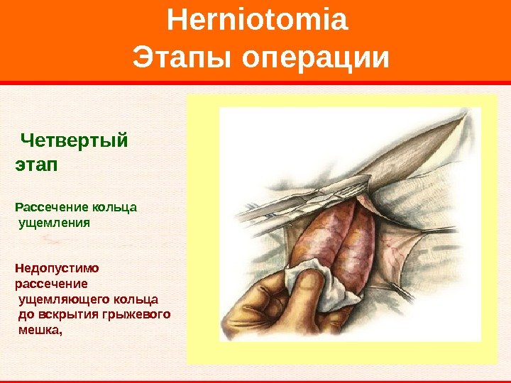   Herniotomia Этапы операции  Четвертый этап  Рассечение кольца  ущемления Недопустимо