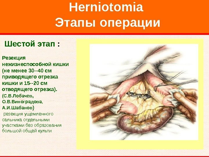   Herniotomia Этапы операции  Шестой этап :  Резекция нежизнеспособной кишки 
