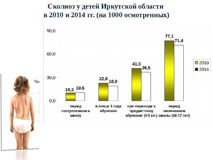   Сколиоз у детей Иркутской области в 2010 и 2014 гг. (на 1000