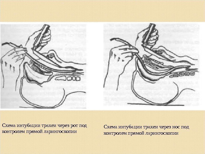 Схема интубации трахеи через рот под контролем прямой ларингоскопии Схема интубации трахеи через нос