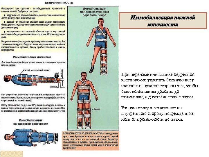 При переломе или вывихе бедренной кости нужно укрепить больную ногу шиной с наружной стороны