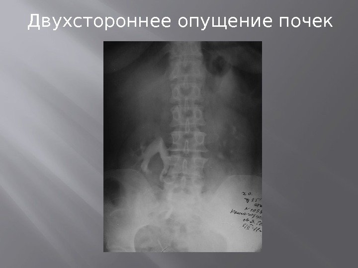 Опущение правой почки. Опущение почки причины. Опущение почек двухстороннее.