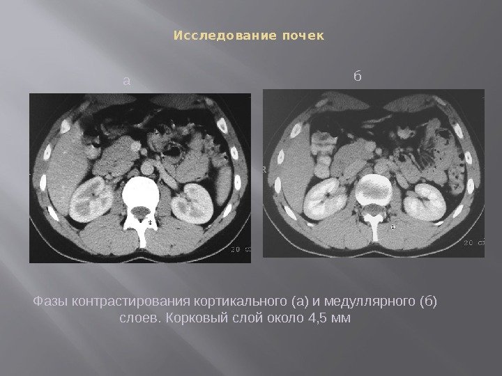 Исследование почек Фазы контрастирования кортикального (а) и медуллярного (б) слоев. Корковый слой около 4,