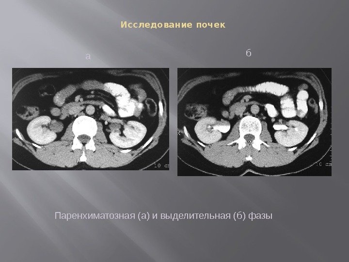 Исследование почек Паренхиматозная (а) и выделительная (б) фазы а б 
