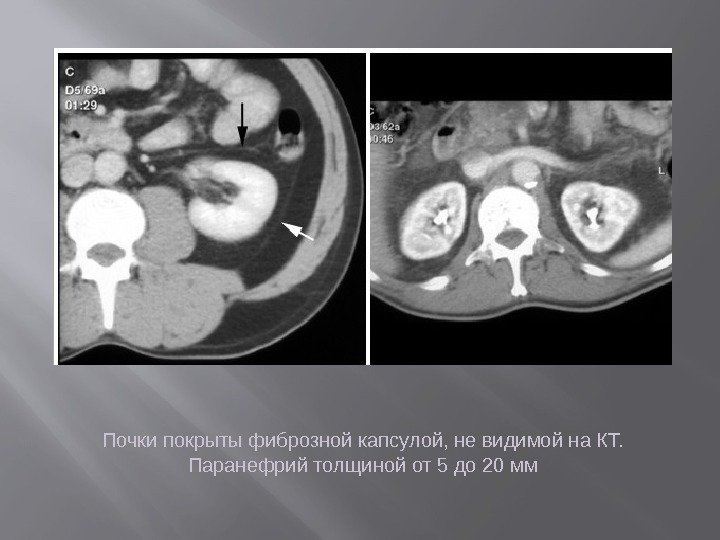 Почки покрыты фиброзной капсулой, не видимой на КТ.  Паранефрий толщиной от 5 до