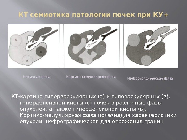 КТ семиотика патологии почек при КУ+ КТ-картина гиперваскулярных (а) и гиповаскулярных (в),  гиперденсивной