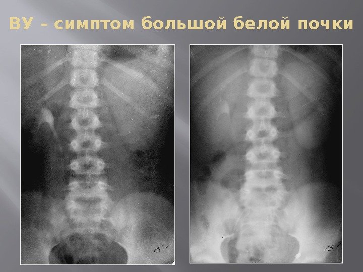 ВУ – симптом большой белой почки 