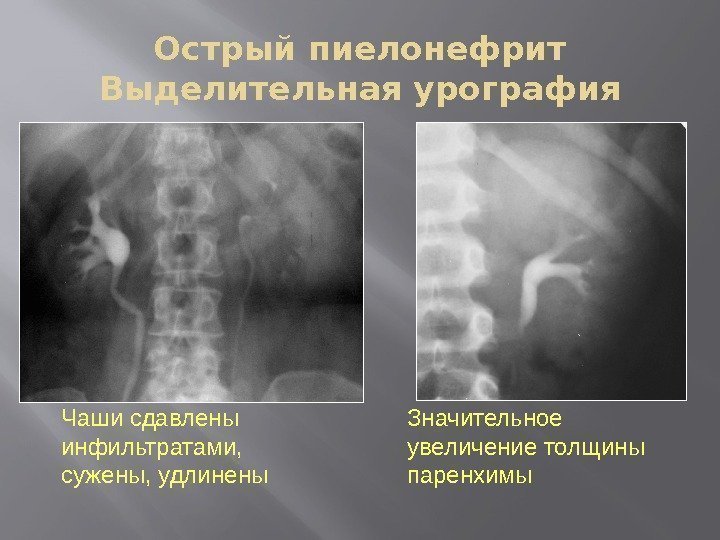 Острый пиелонефрит Выделительная урография Чаши сдавлены инфильтратами,  сужены, удлинены Значительное увеличение толщины паренхимы