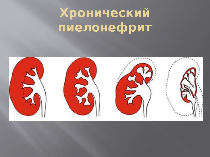 Хронический пиелонефрит 