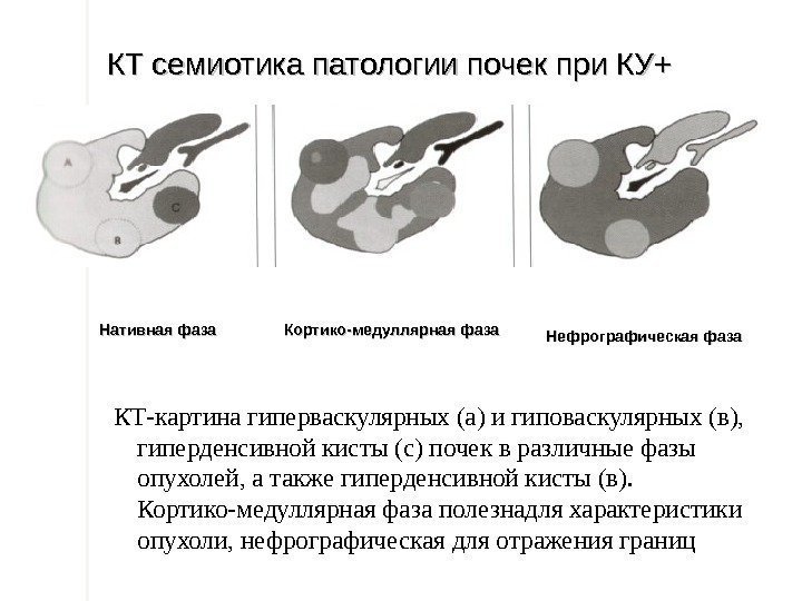 КТ семиотика патологии почек при КУ+ КТ-картина гиперваскулярных (а) и гиповаскулярных (в),  гиперденсивной