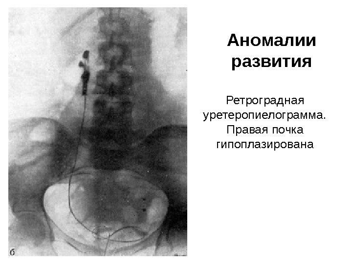 Ретроградная уретеропиелограмма.  Правая почка гипоплазирована Аномалии развития 
