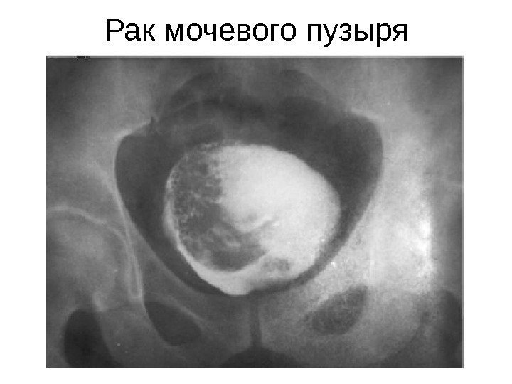 Рак мочевого пузыря 