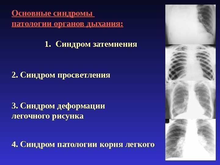 Основные синдромы  патологии органов дыхания: 1. Синдром затемнения 2. Синдром просветления 3. Синдром
