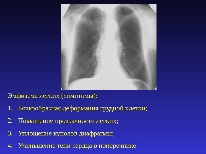 Эмфизема легких (симптомы): 1. Бочкообразная деформация грудной клетки; 2. Повышение прозрачности легких; 3. Уплощение