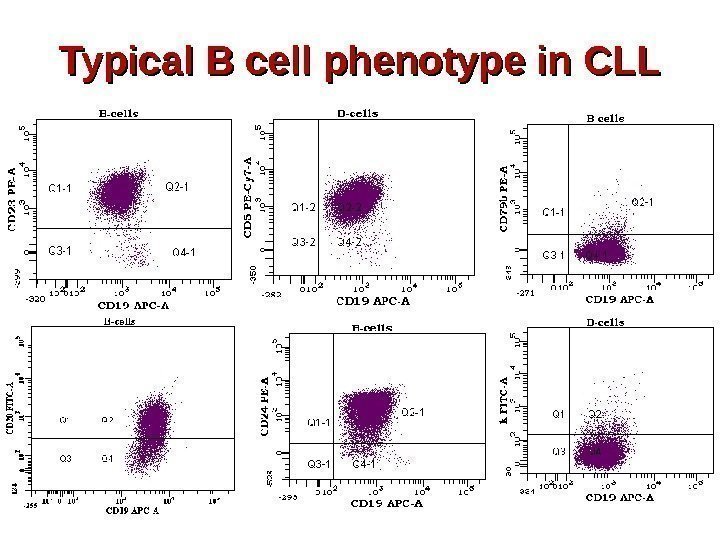 Typical B cell phenotype in CLL 
