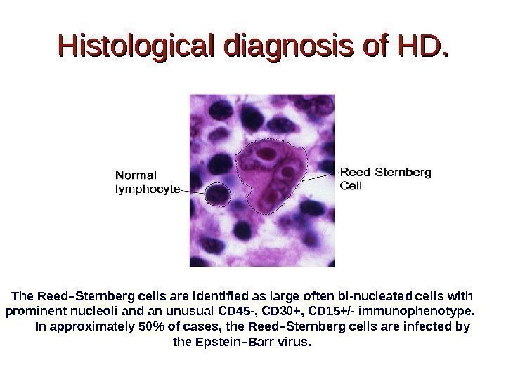 Histological diagnosis of HD. The Reed–Sternberg cells are identified as large often bi-nucleated cells