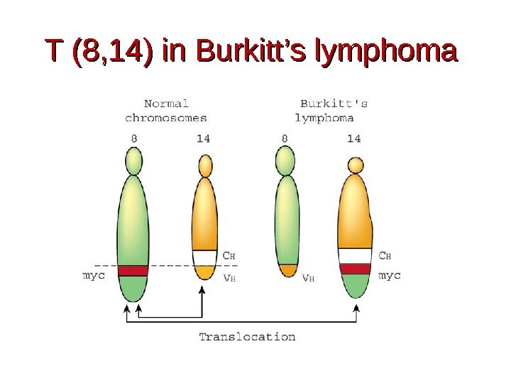 T (8, 14) in Burkitt’s lymphoma 