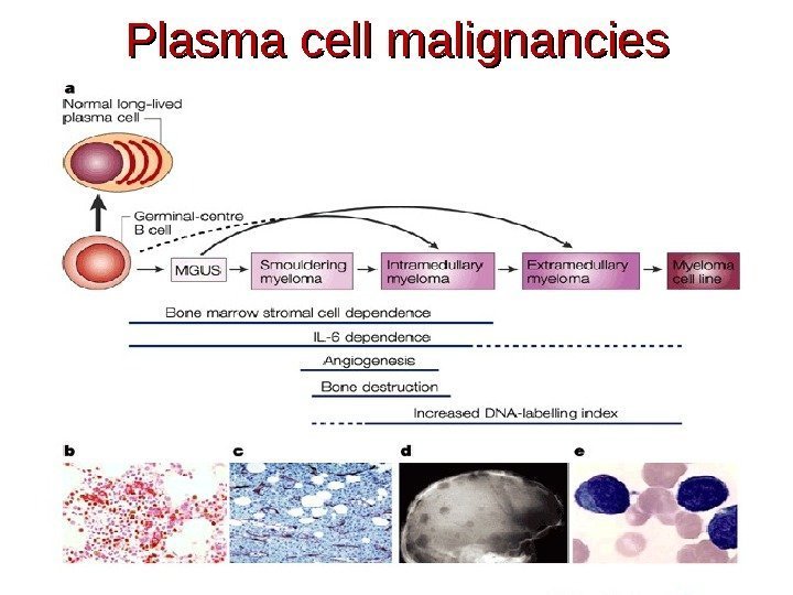 Plasma cell malignancies 