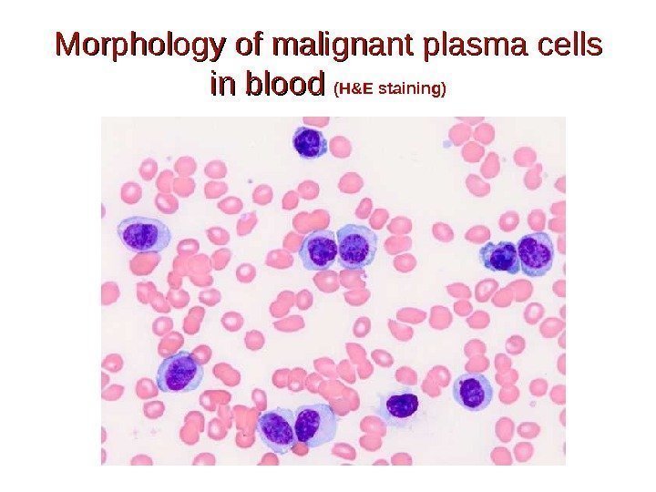 Morphology of malignant plasma cells in blood (H&E staining) 