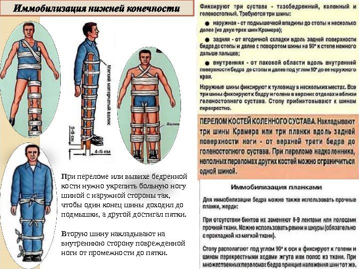 При переломе или вывихе бедренной кости нужно укрепить больную ногу шиной с наружной стороны