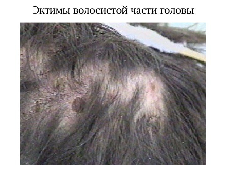 Эктимы волосистой части головы 