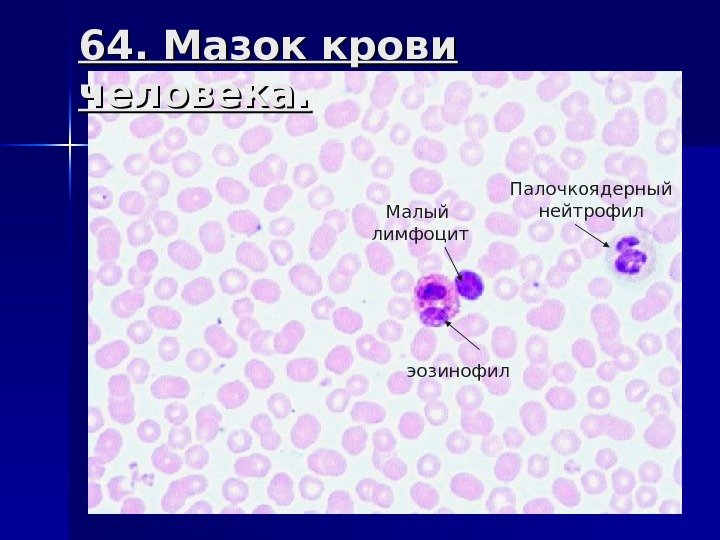 64. Мазок крови человека. эозинофил. Малый лимфоцит Палочкоядерный нейтрофил 