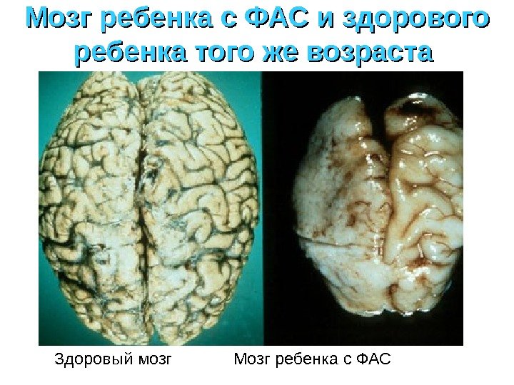 Мозг ребенка с ФАС и здорового ребенка того же возраста  Здоровый мозг 