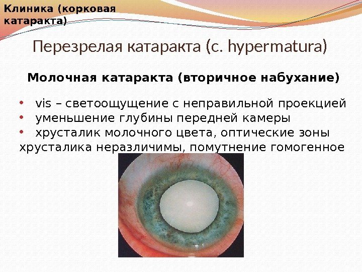 Перезрелая катаракта (c. hypermatura)Клиника Молочная катаракта (вторичное набухание) • vis – светоощущение с неправильной