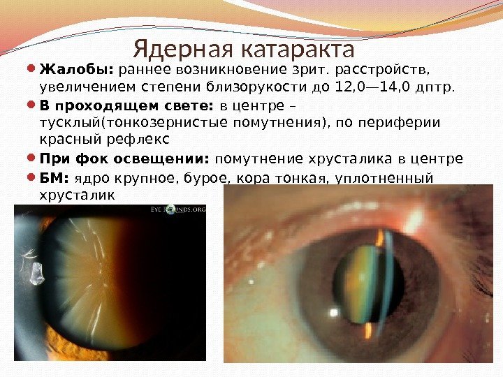 Ядерная катаракта Жалобы:  раннее возникновение зрит. расстройств,  увеличением степени близорукости до 12,
