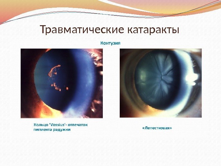 Травматические катаракты 