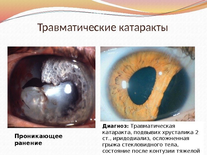 Проникающее ранение Травматические катаракты Диагноз: Травматическая катаракта, подвывих хрусталика 2 ст. , иридодиализ, осложненная