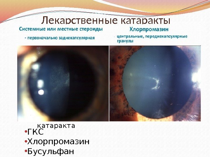 Лекарственные катаракты Стероидная катаракта • ГКС • Хлорпромазин • Бусульфан • Амиодарон • Препараты