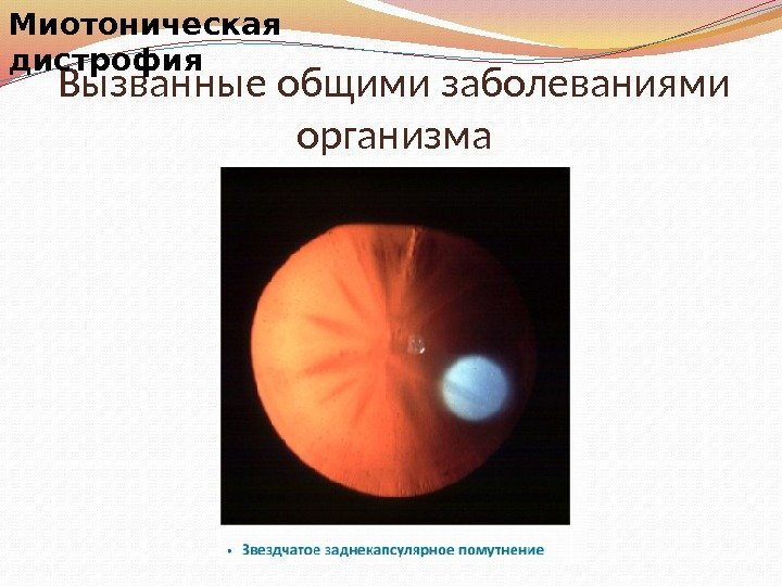 Миотоническая дистрофия. Миотоническая дистрофия частота встречаемости. Формы миотонической дистрофии. Катаракты вызванные общими заболеваниями организма.