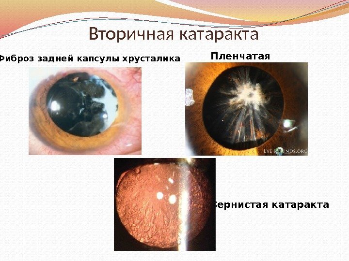 Вторичная катаракта Пленчатая Фиброз задней капсулы хрусталика Зернистая катаракта 