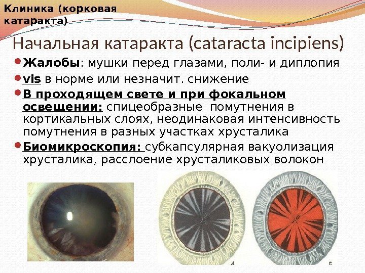 Начальная катаракта (cataracta incipiens) Жалобы : мушки перед глазами, поли- и диплопия vis в