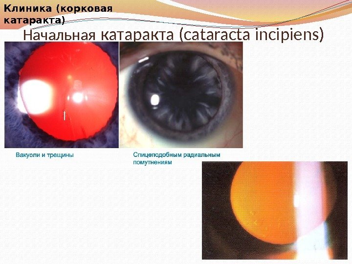 Начальная  катаракта (cataracta incipiens)Клиника (корковая катаракта) 
