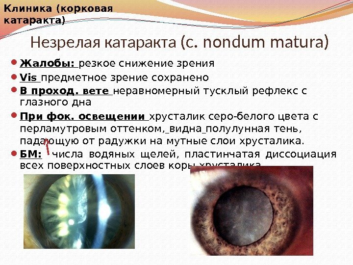 Незрелая катаракта ( c. nondum matura) Жалобы:  резкое снижение зрения Vis предметное зрение
