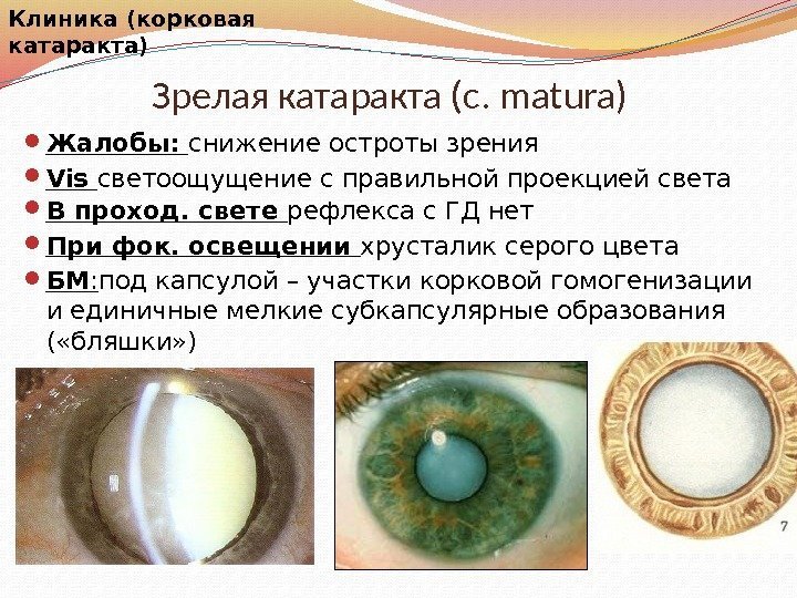Зрелая катаракта (c. matura)Клиника Жалобы:  снижение остроты зрения Vis светоощущение с правильной проекцией