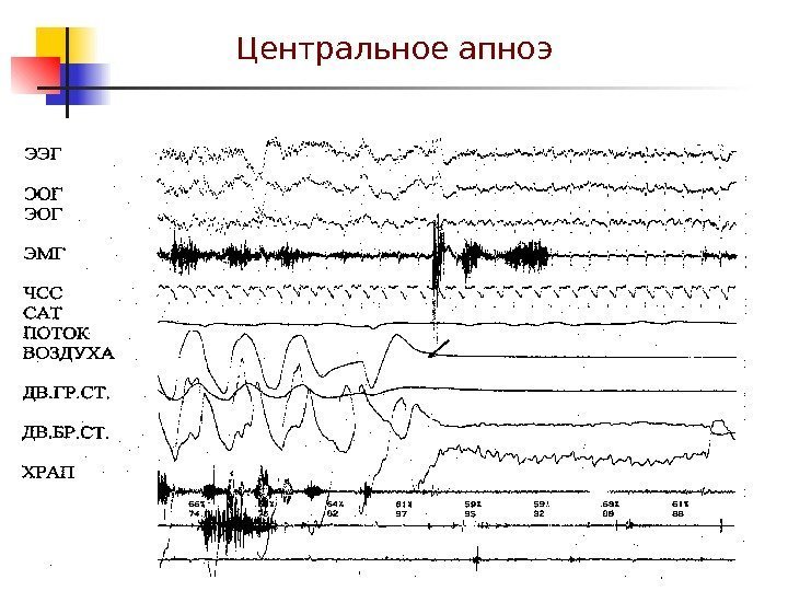   Центральное апноэ 