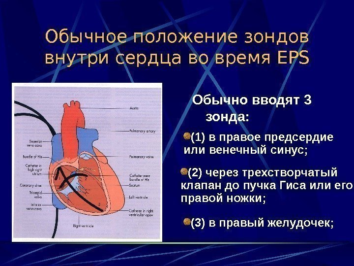   Обычное положение зондов внутри сердца во время EPS Обычно вводят 3 зонда: